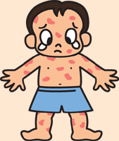 子供の湿疹